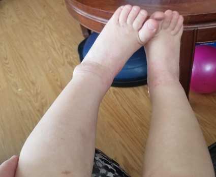 amplifei personal results babies legs2